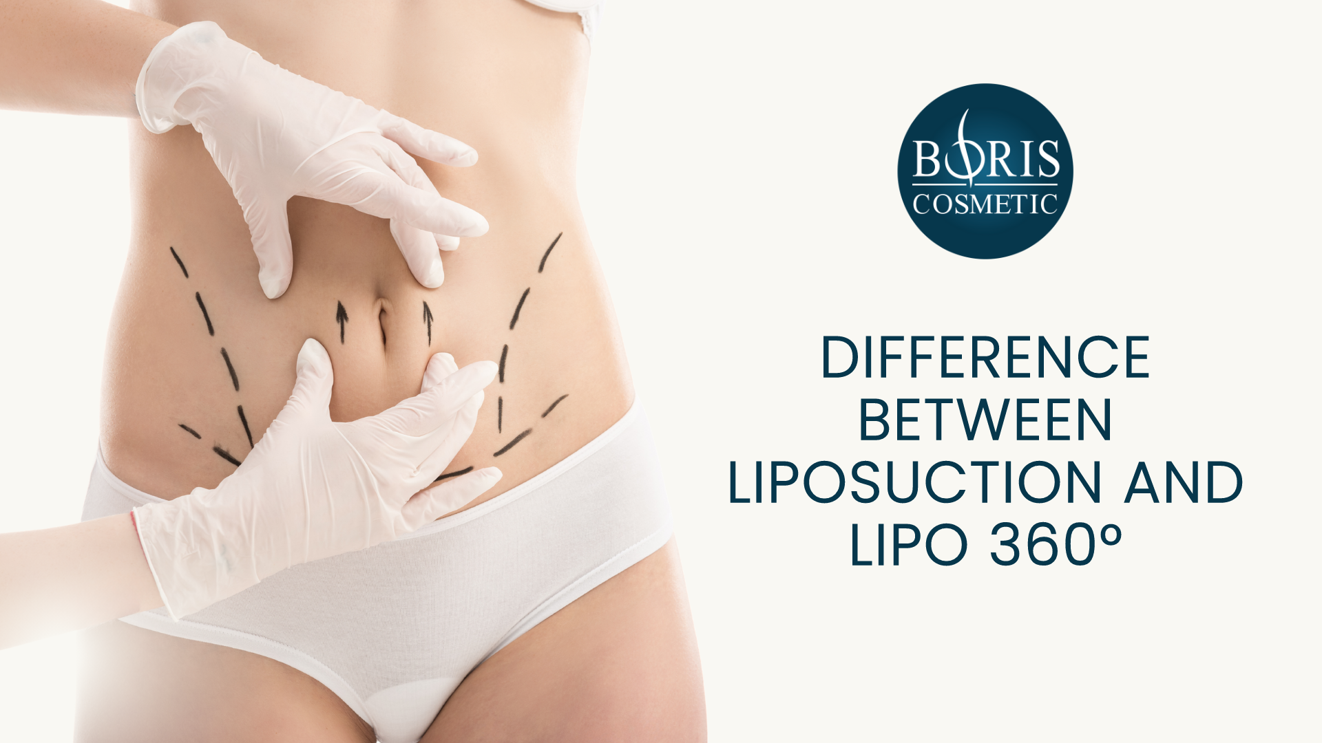 Lipo 360 liposuction abdomen waist hips 360 Lipo