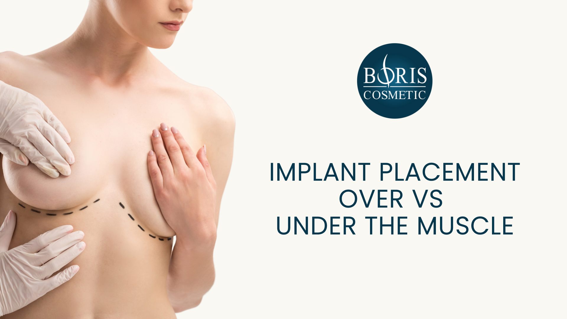 Implant Placement Over VS Under The Muscle