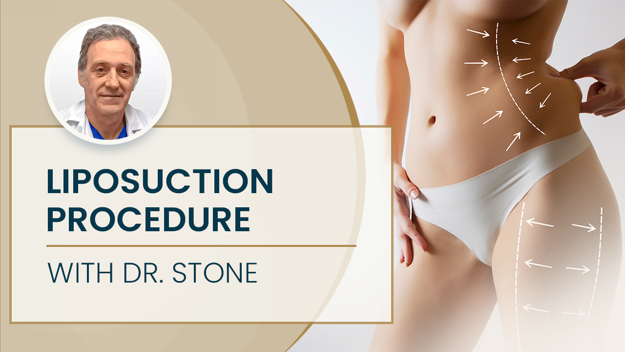 Liposuction Procedure with Dr. Stone